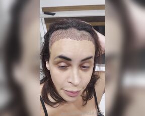 Carla Brasil aka carlabrasil2020 OnlyFans - HAIR TRANSPLANT UPDATE Day 1 and day 5 This video is meant only for those who may be interested